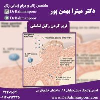 فریز کردن زگیل تناسلی